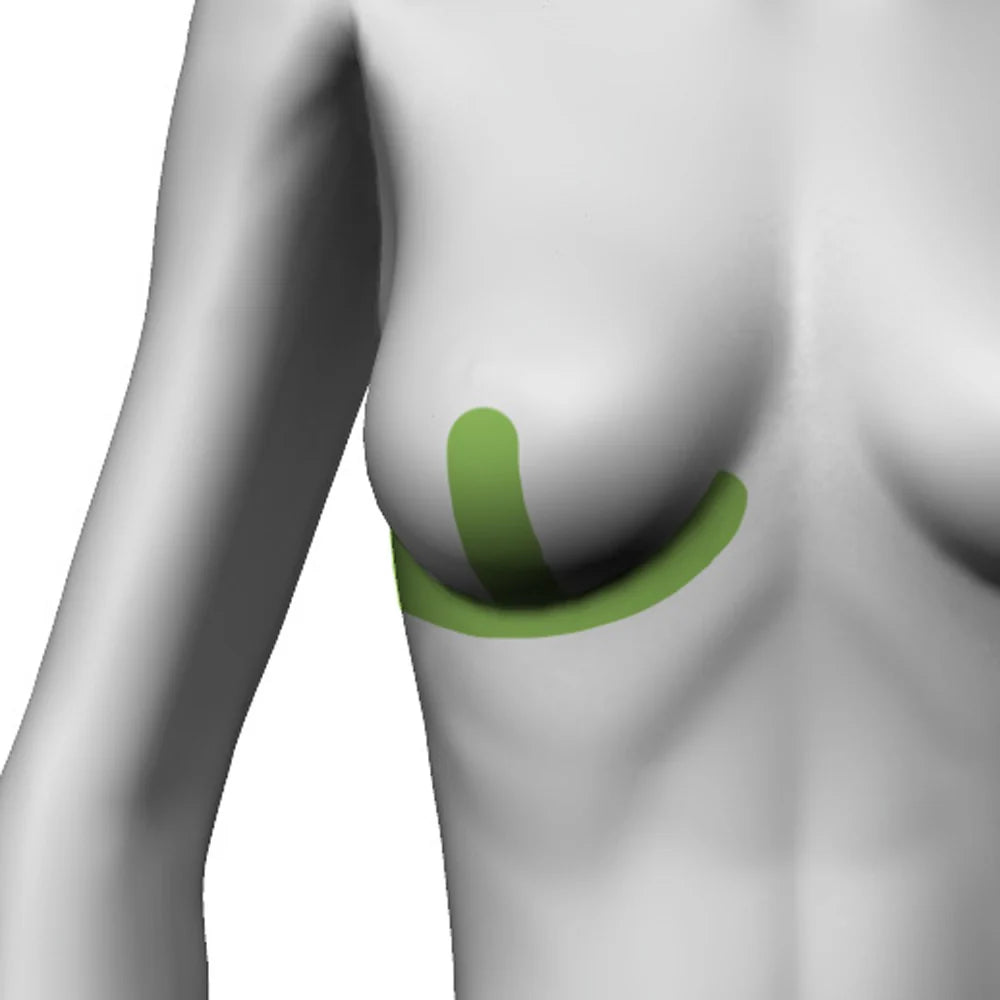 Bandă medicală adezivă silicon pentru tratamentul cicatricilor, forma Ancoră