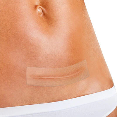 Bandă medicală adezivă silicon pentru tratamentul cicatricilor, 5x20cm